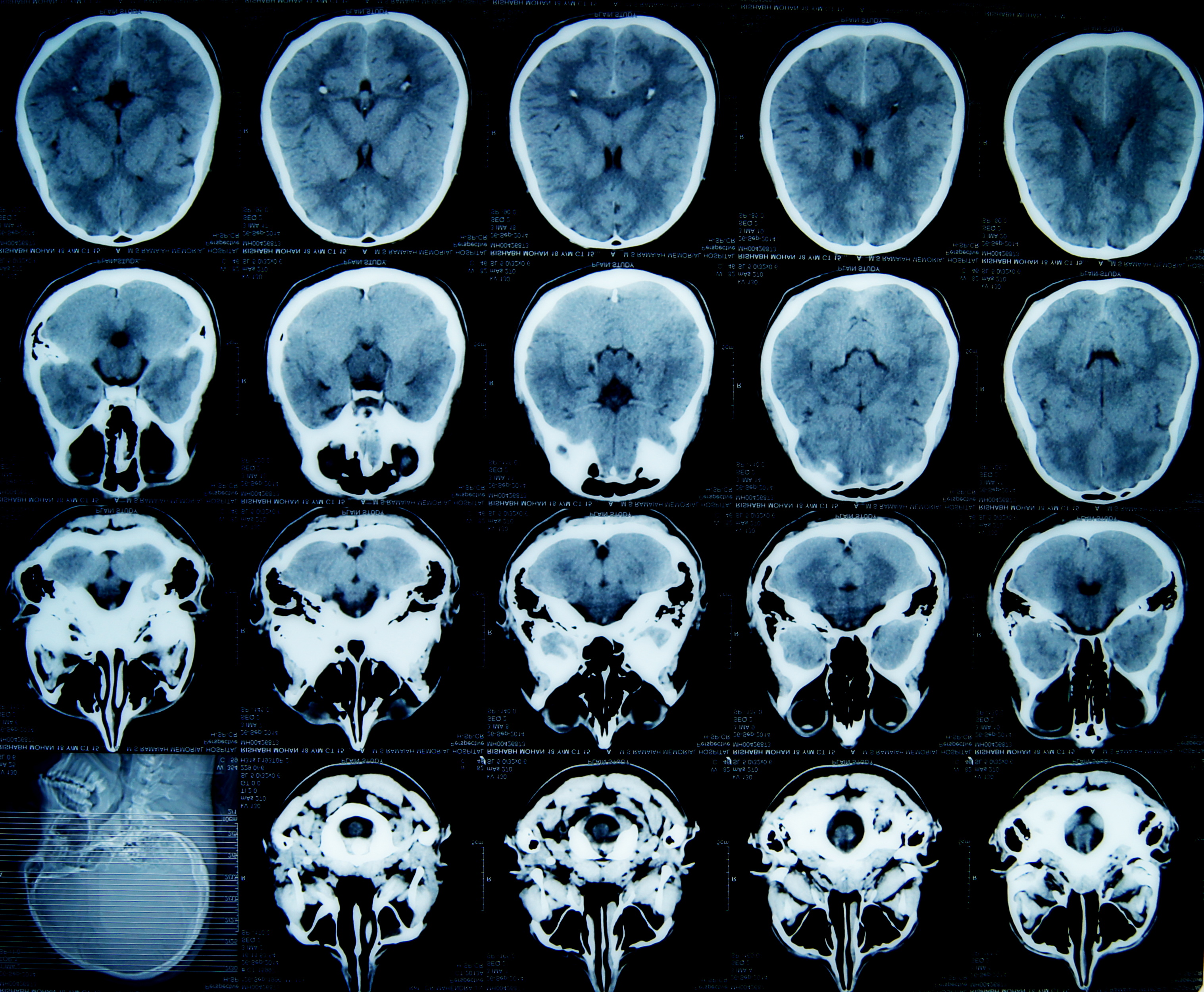 Towards a Clearer Picture in Biomedical Imaging: An Improved Algorithm for Photo Acoustic Tomography